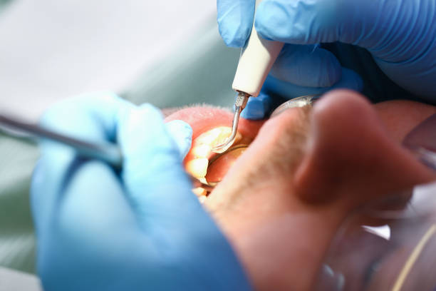 Best Emergency Root Canal Treatment in Campton Hls, IL